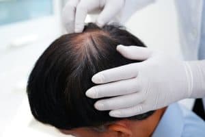 Medical staff looking at a man’s balding scalp before hair drug test